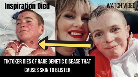 marky jaquez|TikToker Dies of Rare Genetic Disease That Causes Skin to Blister